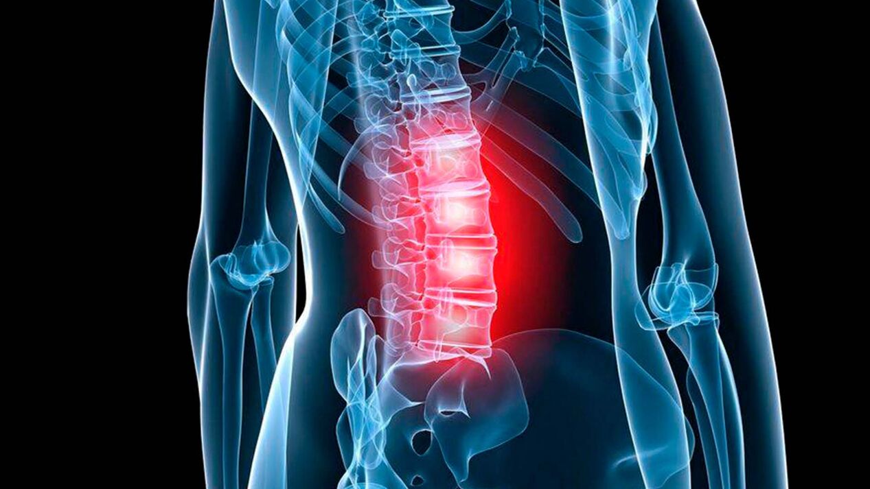 lumbar osteochondrosis symptoms